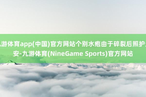 九游体育app(中国)官方网站个别水疱由于碎裂后照护欠安-九游体育(NineGame Sports)官方网站